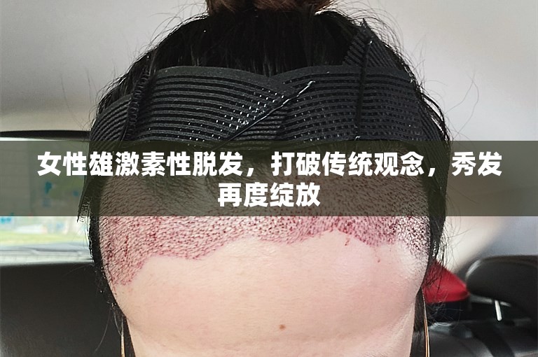 女性雄激素性脱发，打破传统观念，秀发再度绽放