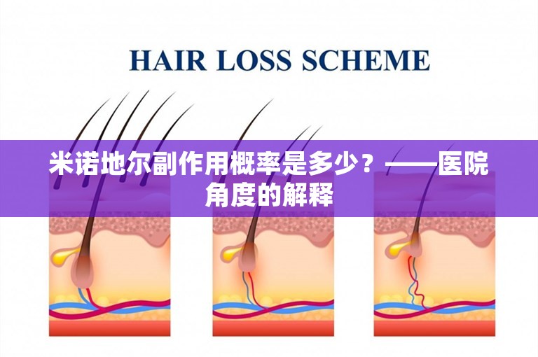 米诺地尔副作用概率是多少？——医院角度的解释