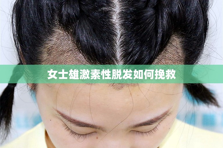 女士雄激素性脱发如何挽救