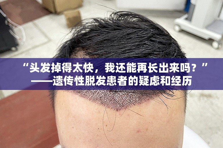  “头发掉得太快，我还能再长出来吗？”——遗传性脱发患者的疑虑和经历