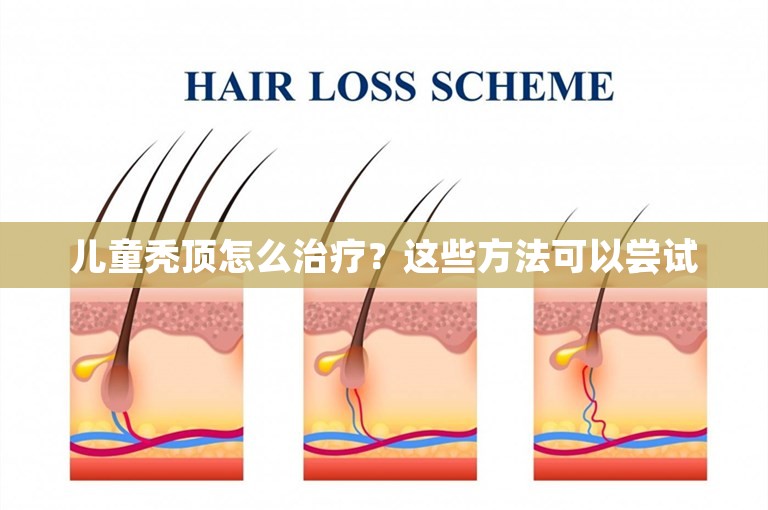 儿童秃顶怎么治疗？这些方法可以尝试