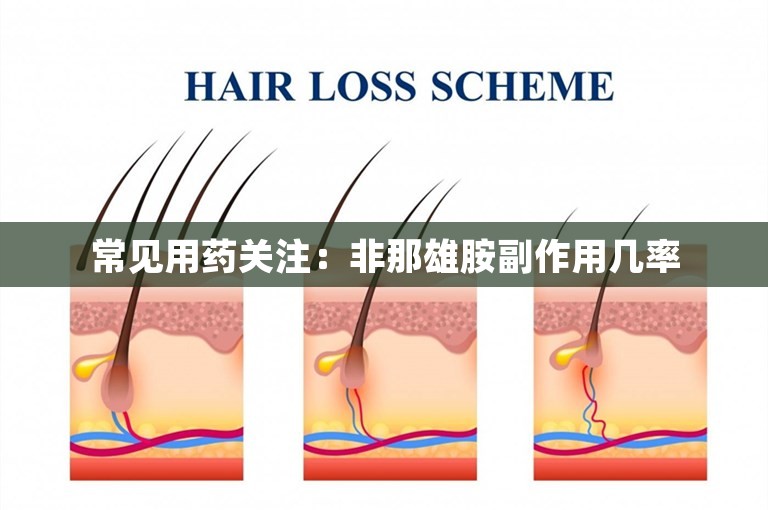 常见用药关注：非那雄胺副作用几率