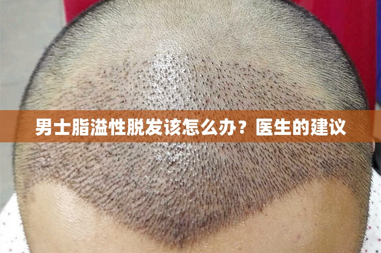 男士脂溢性脱发该怎么办？医生的建议