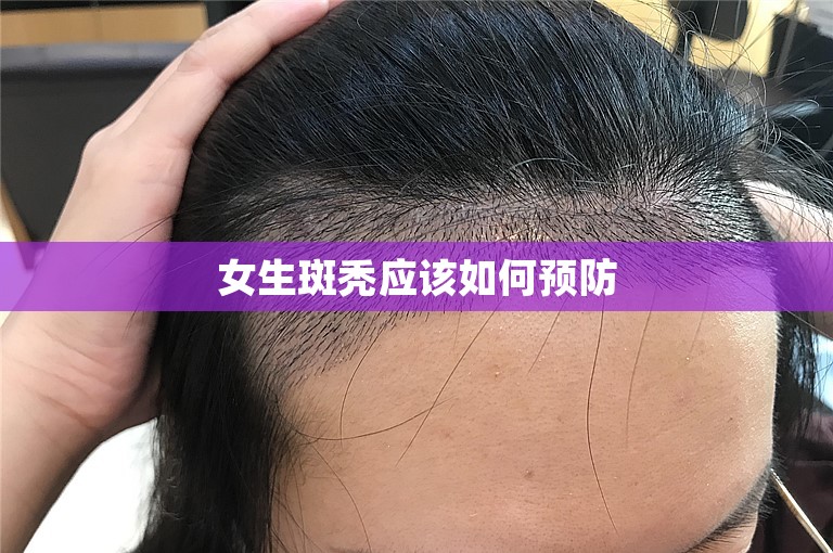 女生斑秃应该如何预防