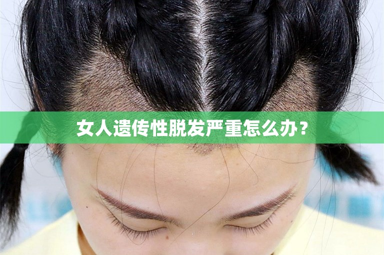 女人遗传性脱发严重怎么办？