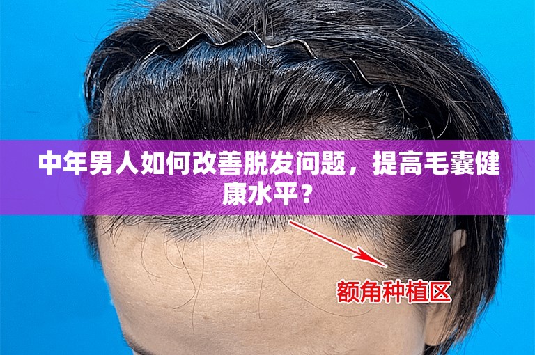 中年男人如何改善脱发问题，提高毛囊健康水平？