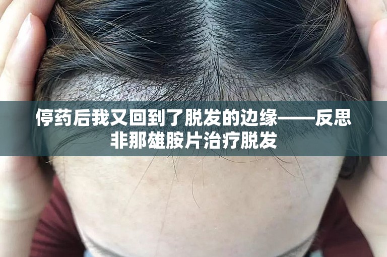 停药后我又回到了脱发的边缘——反思非那雄胺片治疗脱发