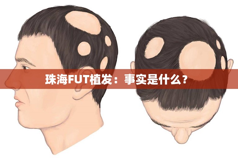  珠海FUT植发：事实是什么？ 