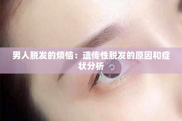 男人脱发的烦恼：遗传性脱发的原因和症状分析