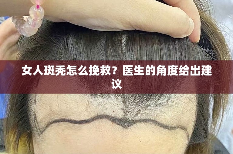 女人斑秃怎么挽救？医生的角度给出建议