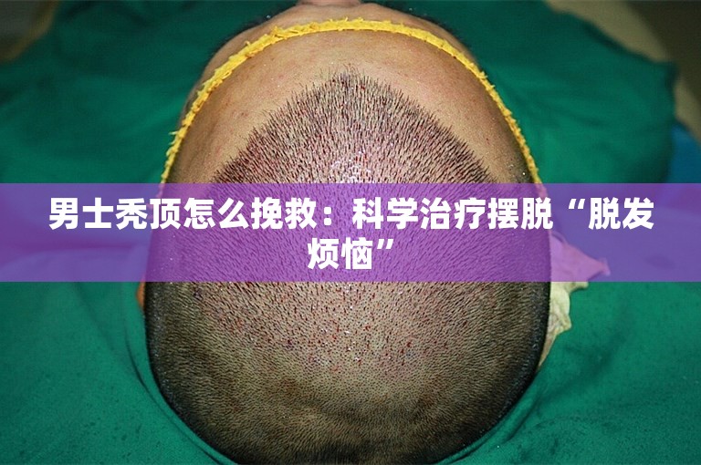 男士秃顶怎么挽救：科学治疗摆脱“脱发烦恼”