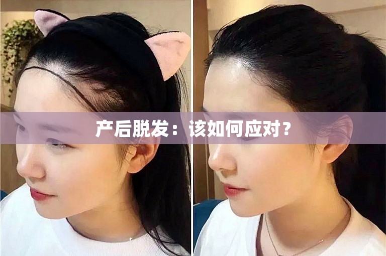 产后脱发：该如何应对？