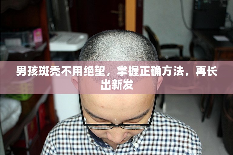 男孩斑秃不用绝望，掌握正确方法，再长出新发