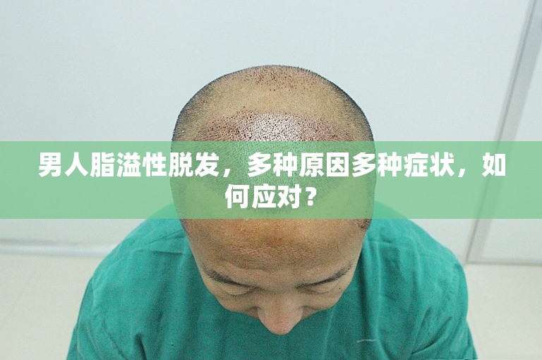 男人脂溢性脱发，多种原因多种症状，如何应对？