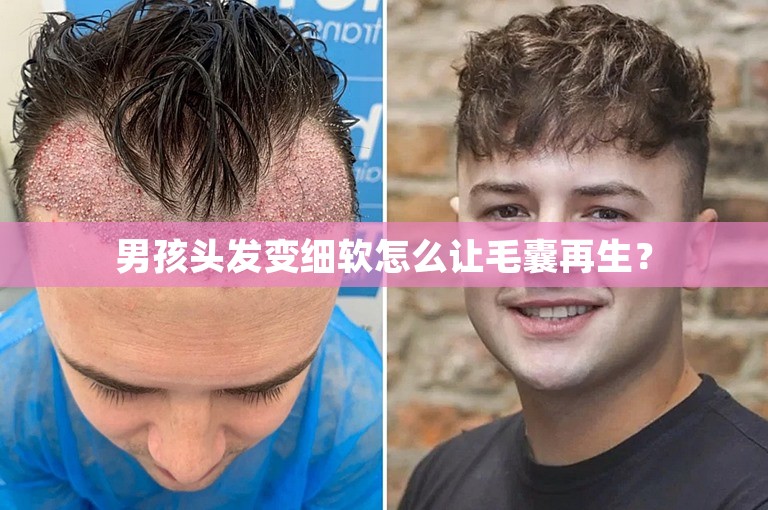 男孩头发变细软怎么让毛囊再生？