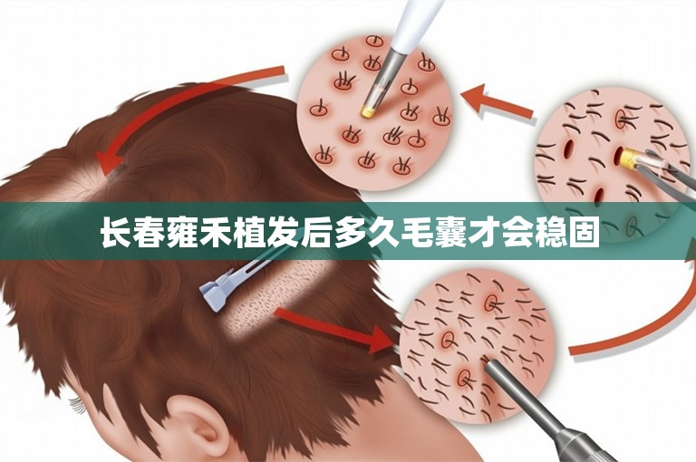 长春雍禾植发后多久毛囊才会稳固