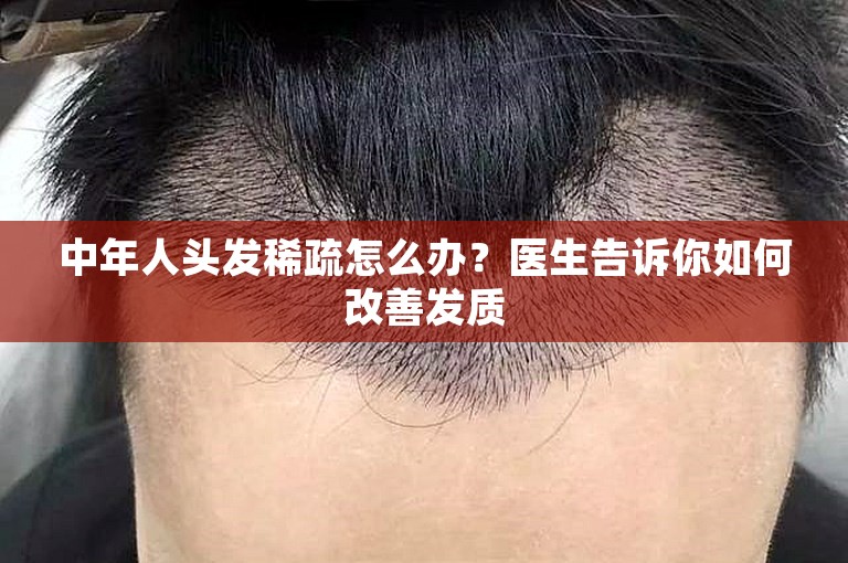 中年人头发稀疏怎么办？医生告诉你如何改善发质