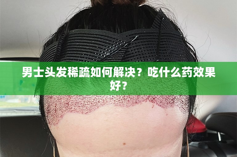 男士头发稀疏如何解决？吃什么药效果好？