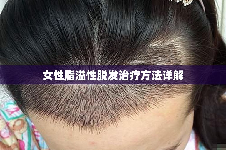 女性脂溢性脱发治疗方法详解