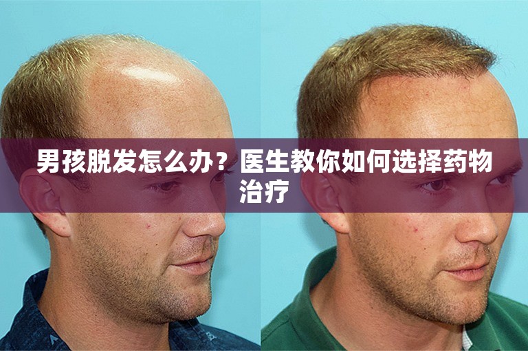 男孩脱发怎么办？医生教你如何选择药物治疗