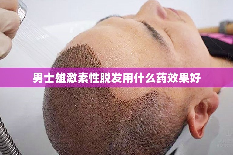 男士雄激素性脱发用什么药效果好