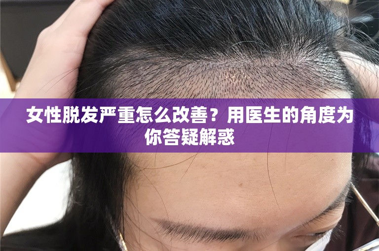 女性脱发严重怎么改善？用医生的角度为你答疑解惑