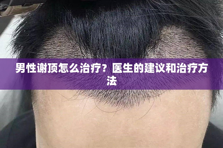 男性谢顶怎么治疗？医生的建议和治疗方法