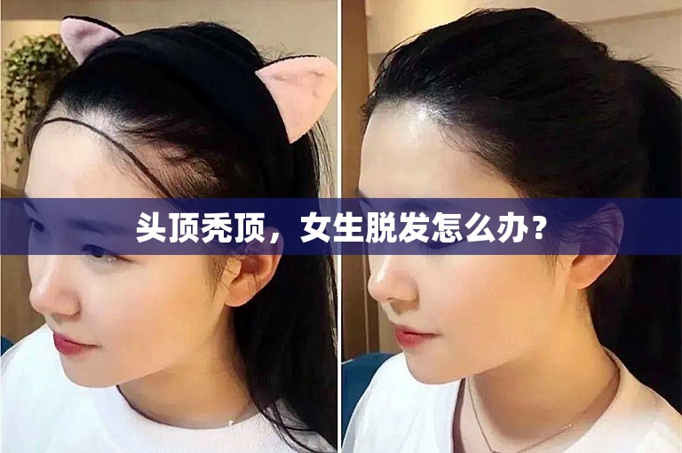 头顶秃顶，女生脱发怎么办？