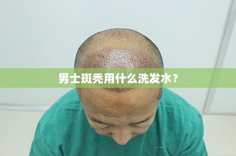 男士斑秃用什么洗发水？