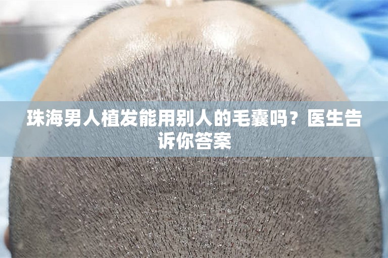 珠海男人植发能用别人的毛囊吗？医生告诉你答案