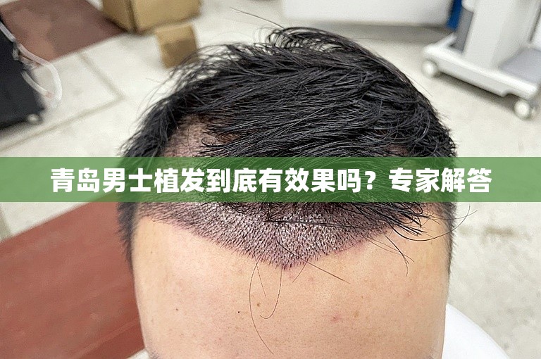 青岛男士植发到底有效果吗？专家解答