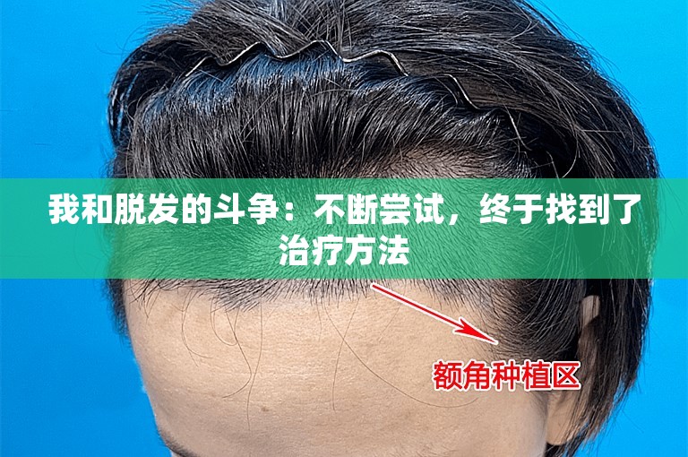 我和脱发的斗争：不断尝试，终于找到了治疗方法