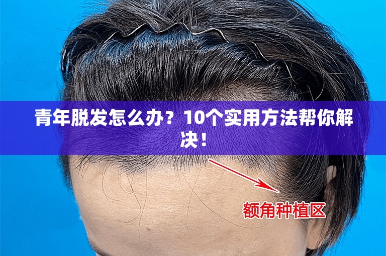 青年脱发怎么办？10个实用方法帮你解决！