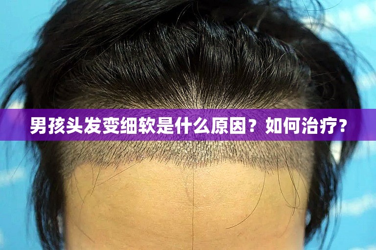 男孩头发变细软是什么原因？如何治疗？