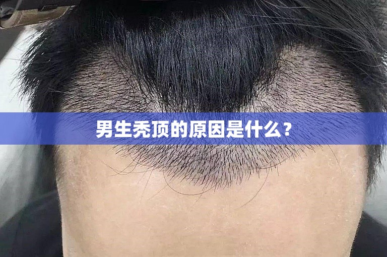 男生秃顶的原因是什么？