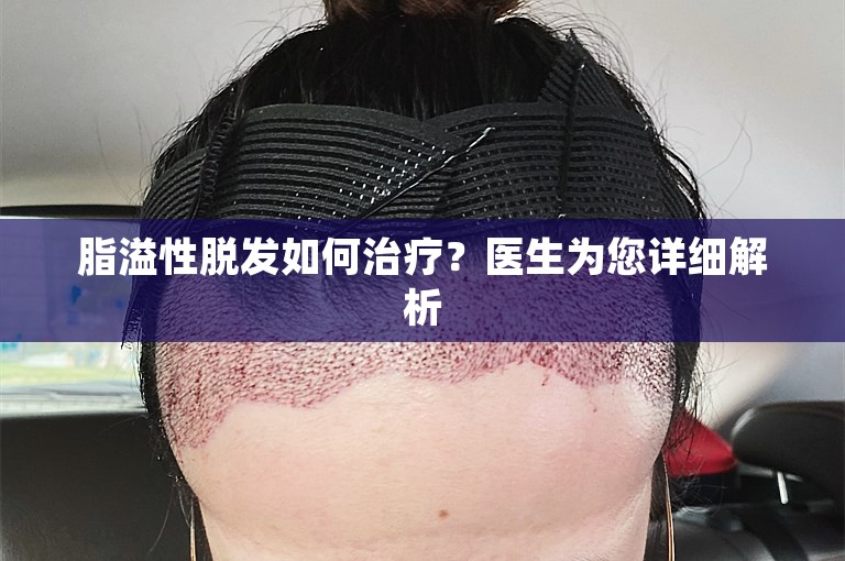 脂溢性脱发如何治疗？医生为您详细解析