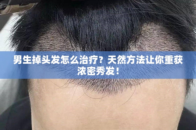 男生掉头发怎么治疗？天然方法让你重获浓密秀发！