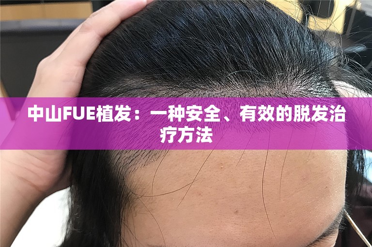 中山FUE植发：一种安全、有效的脱发治疗方法