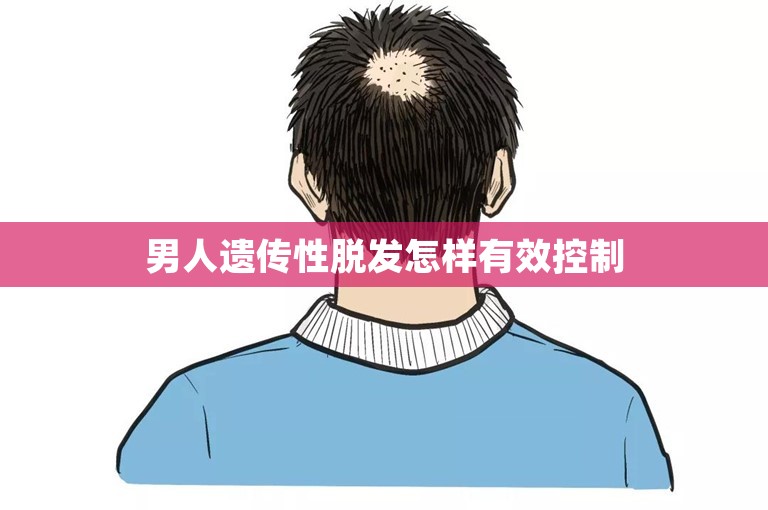 男人遗传性脱发怎样有效控制