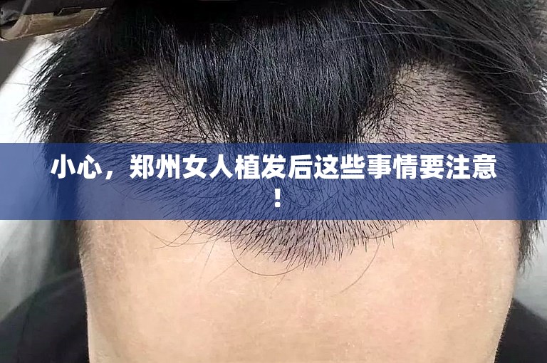 小心，郑州女人植发后这些事情要注意！