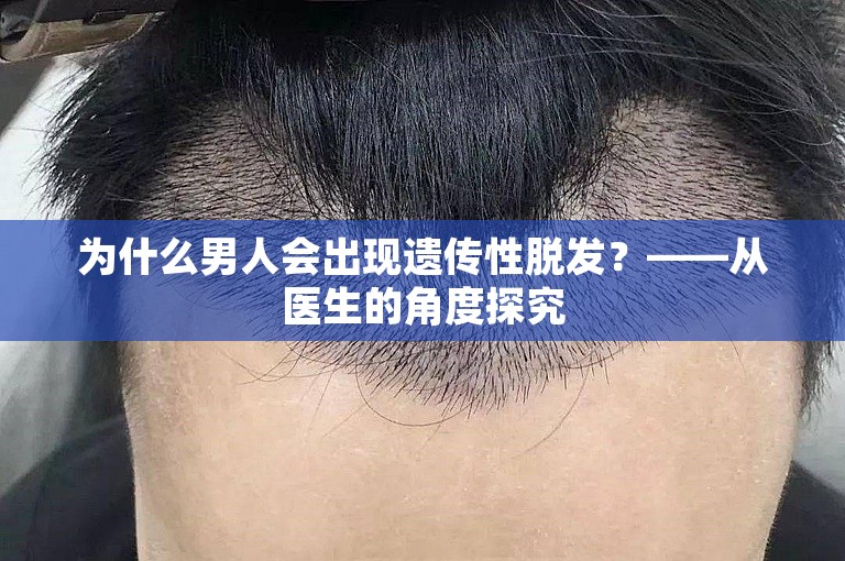 为什么男人会出现遗传性脱发？——从医生的角度探究