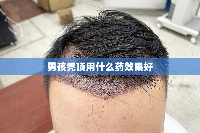 男孩秃顶用什么药效果好