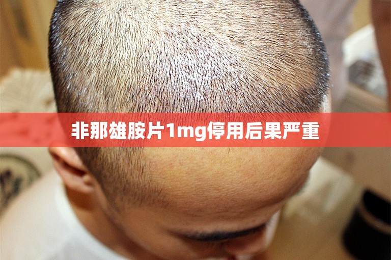  非那雄胺片1mg停用后果严重 