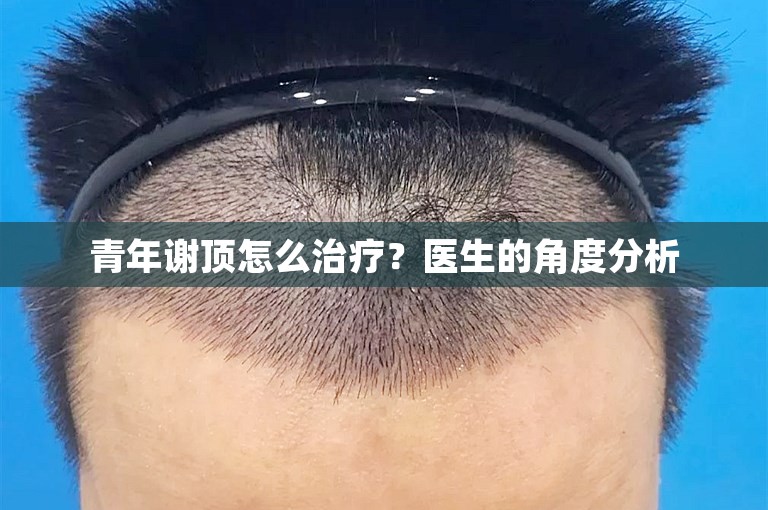 青年谢顶怎么治疗？医生的角度分析