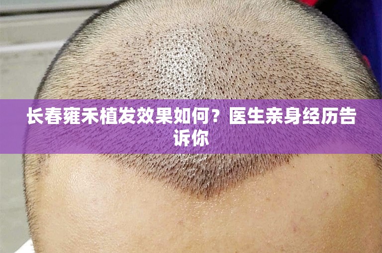 长春雍禾植发效果如何？医生亲身经历告诉你