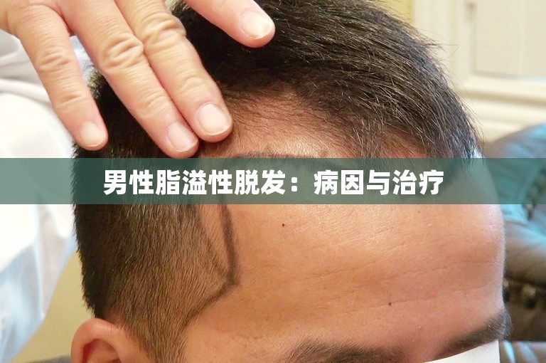 男性脂溢性脱发：病因与治疗