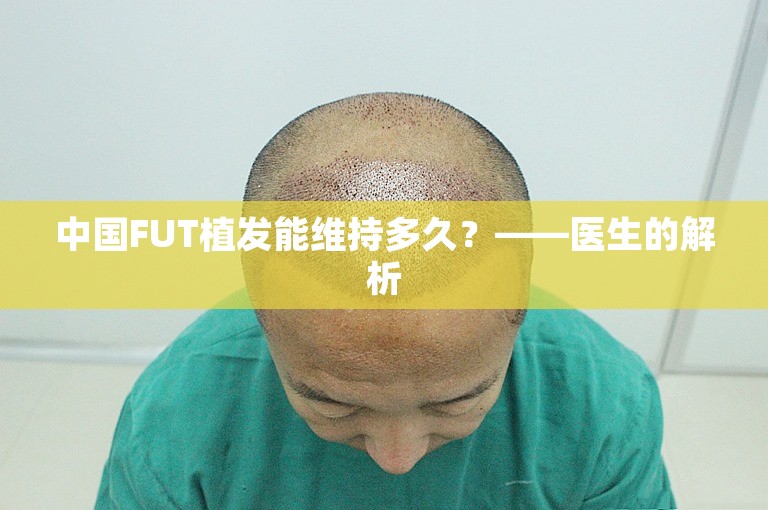 中国FUT植发能维持多久？——医生的解析