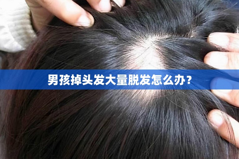 男孩掉头发大量脱发怎么办？