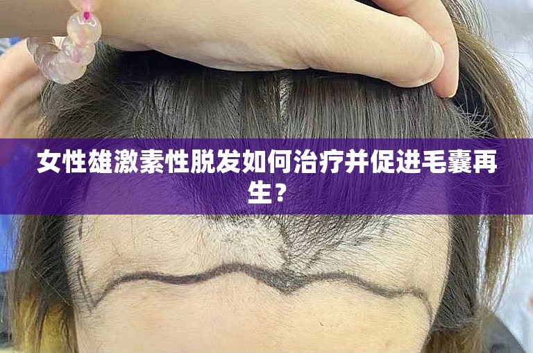 女性雄激素性脱发如何治疗并促进毛囊再生？