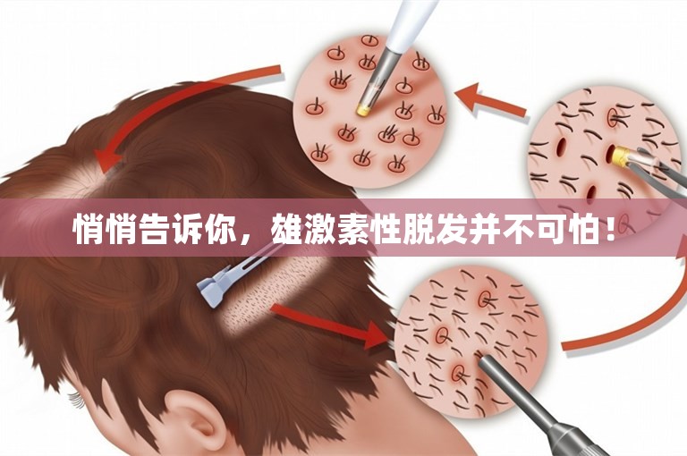 悄悄告诉你，雄激素性脱发并不可怕！